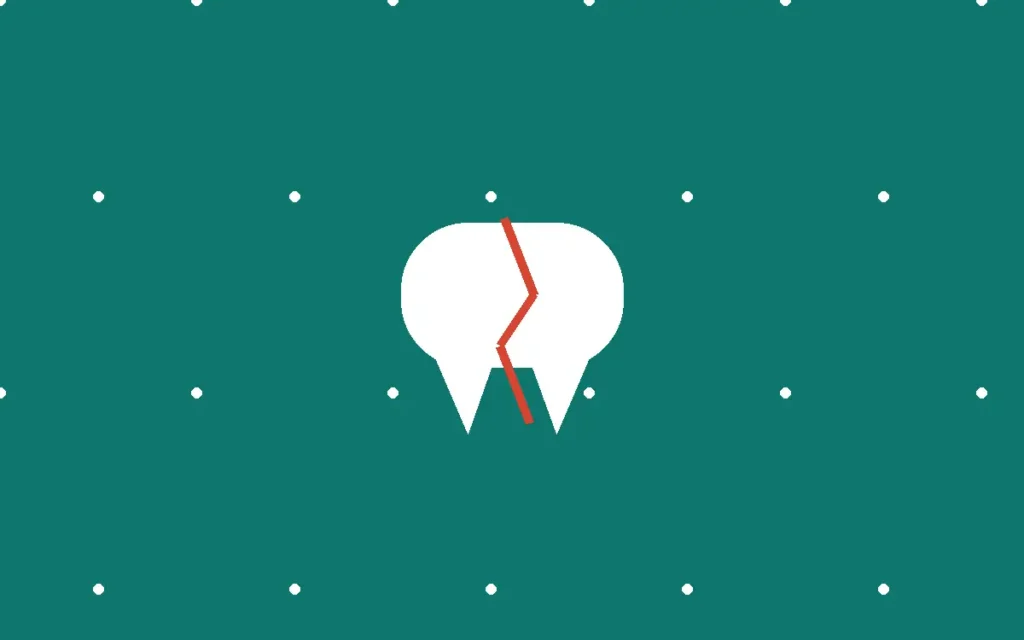Illustration of broken tooth repair in Alpharetta