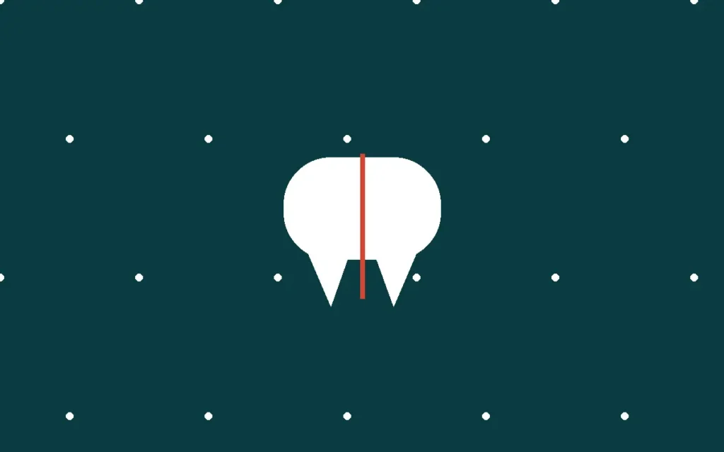 Illustration representing an emergency root canal in Alpharetta