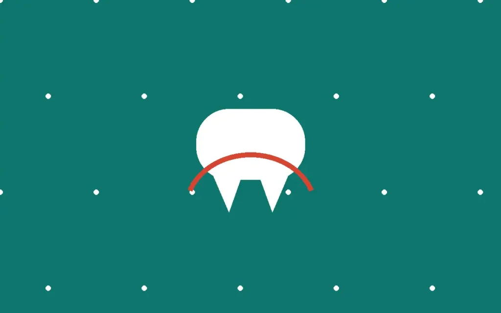 Illustration of emergency wisdom tooth extraction in Alpharetta